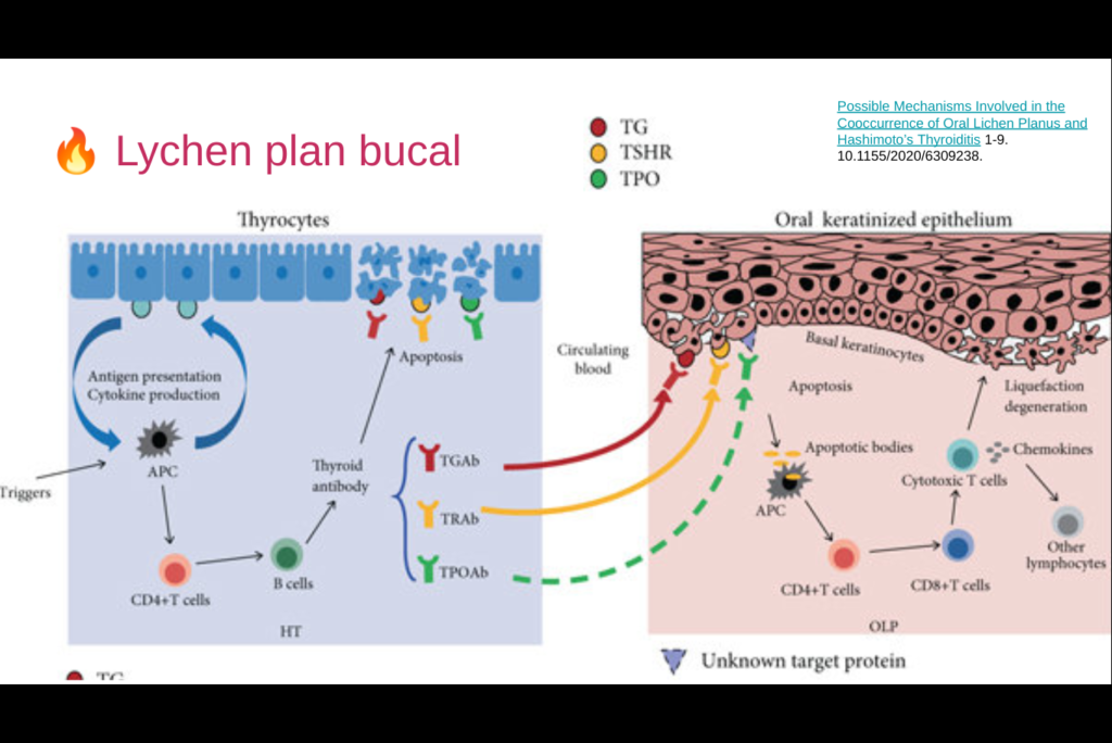 anticorp anti thyroglobuline élevé lichen plan buccal