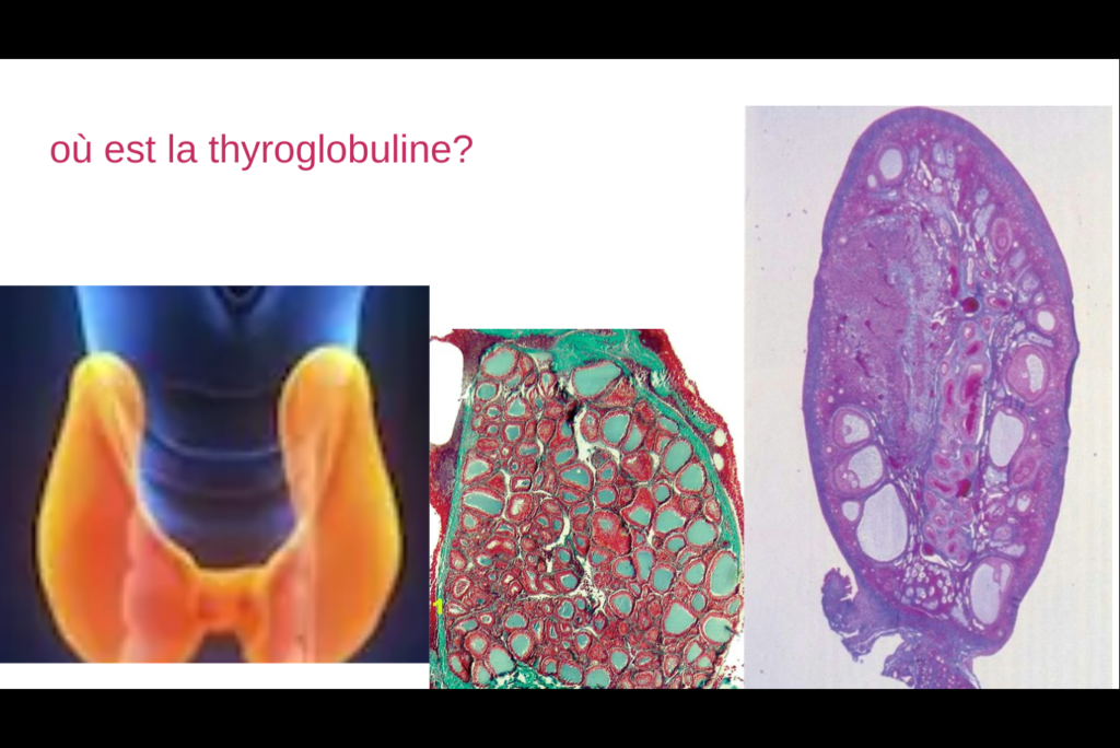 anticorp anti thyroglobuline eleve coupe de thyroïde