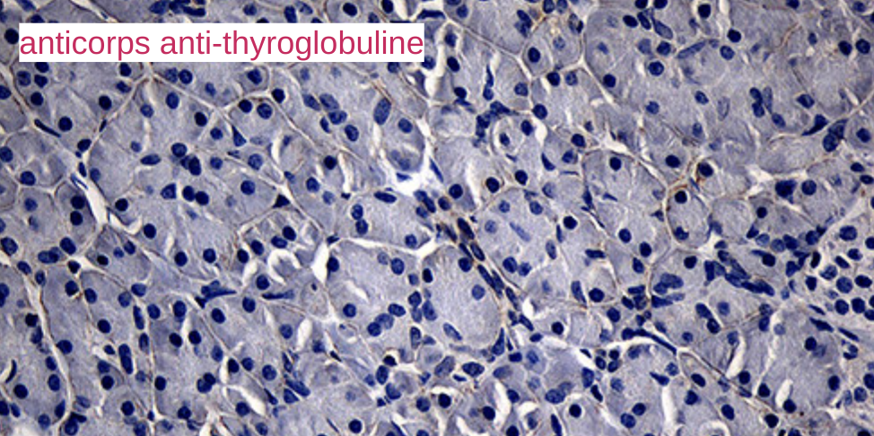 anticorp anti thyroglobuline élevé fausse image