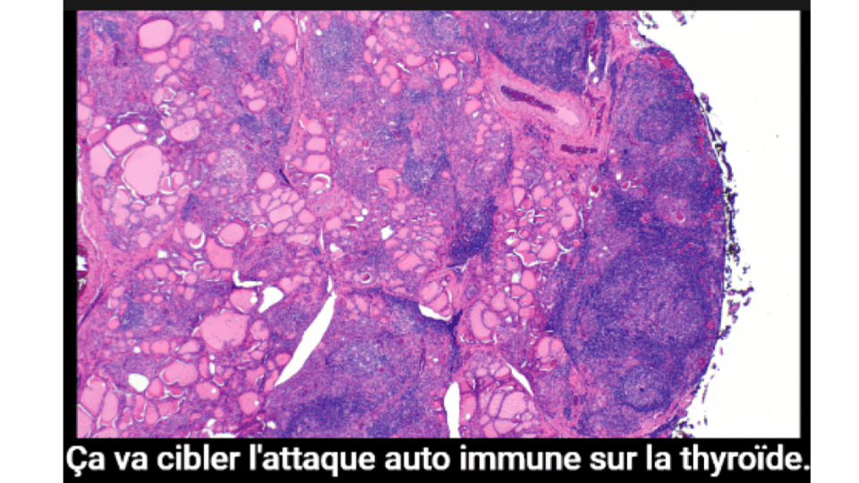 La prise d'un supplément d'iode provoque une infiltration lymphocytaire caractéristique de la thyroïdite de Hashimoto