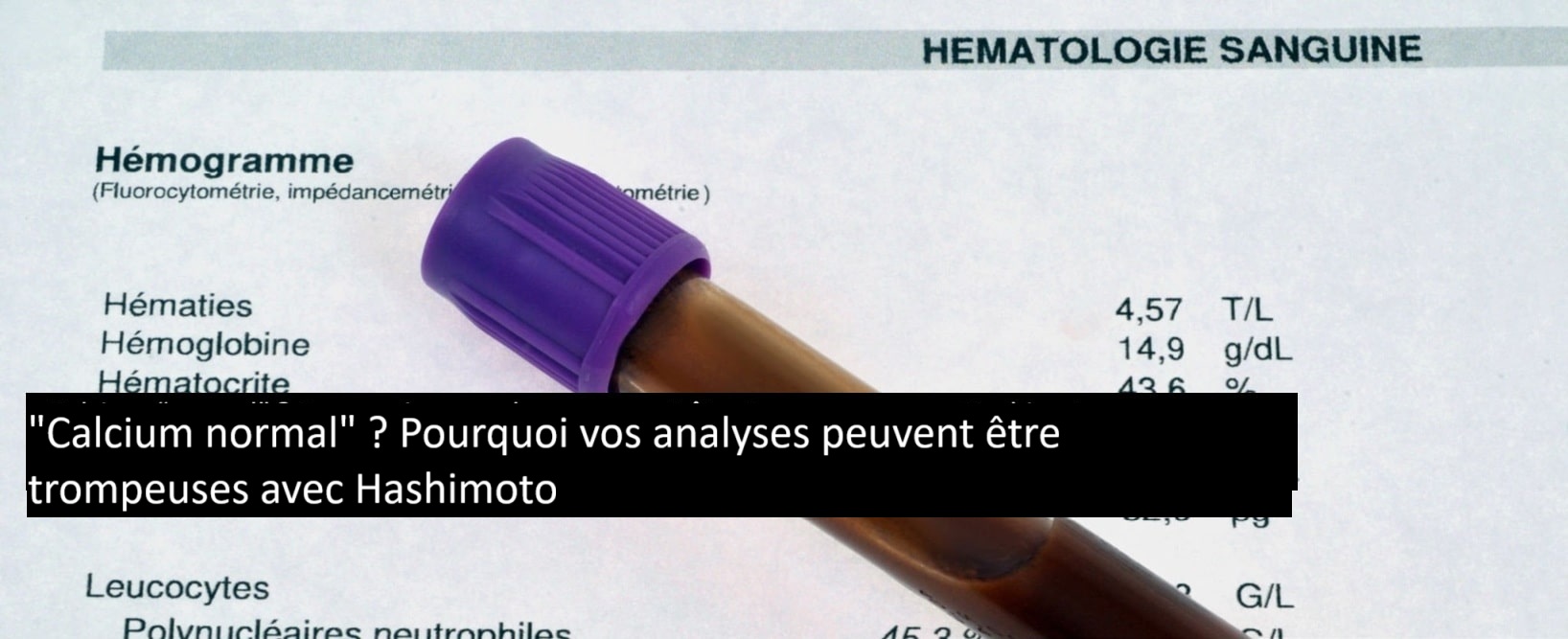 Bilan sanguin avec tube de prélèvement pour explorer le calcium et la thyroïde chez une patiente Hashimoto.